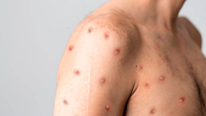 Que no cunda el pánico: Mpox no es la nueva COVID-19 (pero no hay que bajar la guardia)