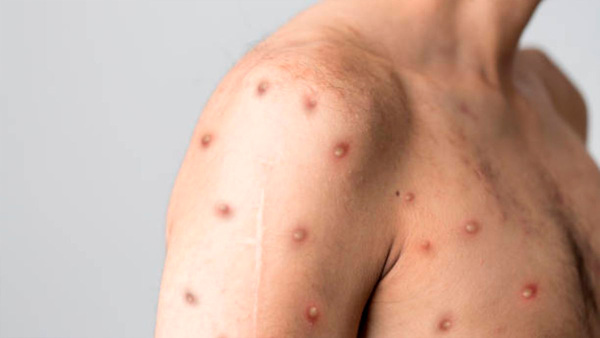 Que no cunda el pánico: Mpox no es la nueva COVID-19 (pero no hay que bajar la guardia)