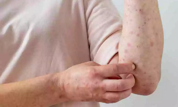 Descartan un caso de viruela del mono en ñande Retá