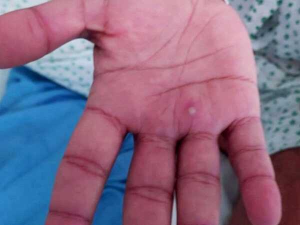 Caso de viruela símica en el país resulto ser una falsa alarma