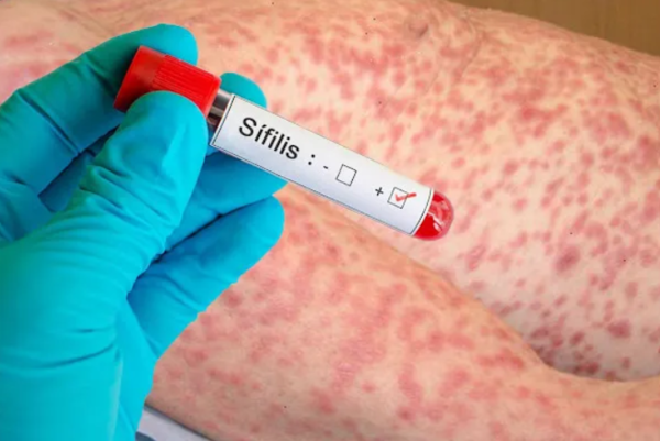 ¡Chake! Saltan las alarmas por aumento de casos de sífilis en nuestro país