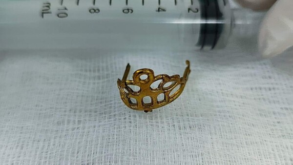 Bebé tragó la coronita de su muñeca y fue intervenida de urgencia
