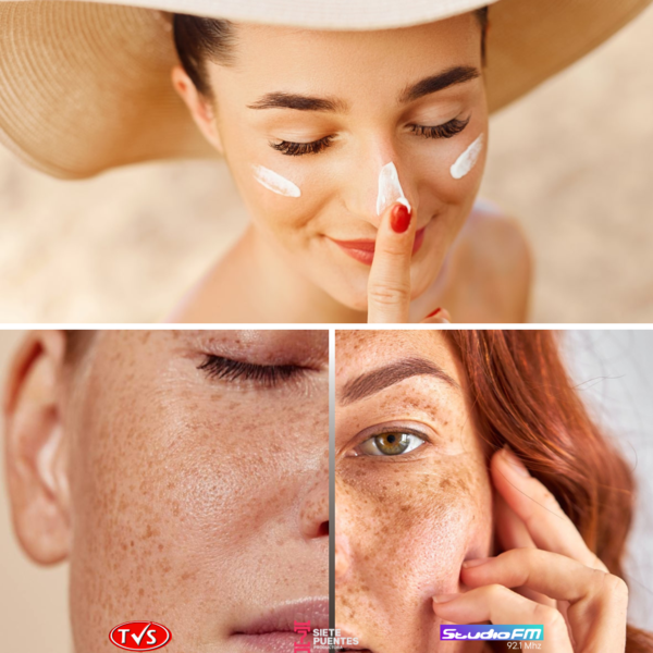 CUIDADO DERMATOLÓGICO PARA MELASMA Y PECAS: RECOMENDACIONES DE LA DRA. SILVANA NEGRELLI - TVS
