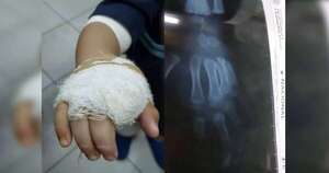 Diario HOY | Niño pierde un dedo tras sufrir brutal ataque de un perro en Ypané