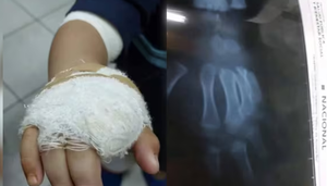 Niño pierde un dedo tras sufrir brutal ataque de un perro en Ypané - Noticiero Paraguay