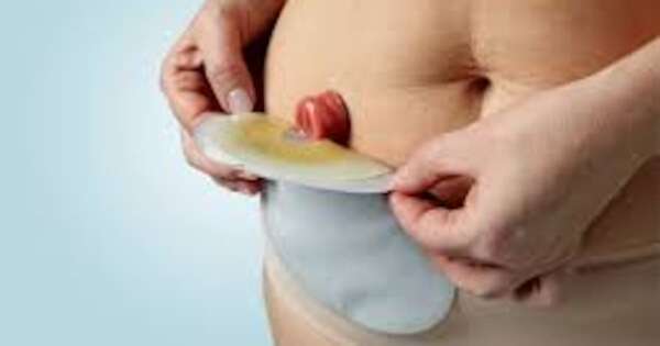 Diario HOY | Los retos psicológicos de la Ostomía, el estigma invisible