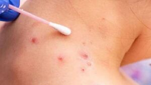 OMS aprueba el primer test para diagnosticar mpox