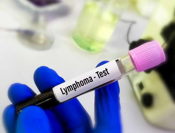 Linfomas: ¿cuál es la tasa de supervivencia según la etapa del cáncer? - Estilo de vida - ABC Color