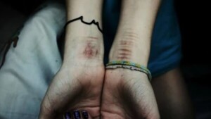 Síndrome de cutting o autolesión en adolescentes: médico habla de un alarmante aumento