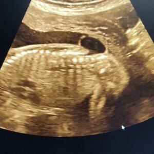 Con éxito, realizan cuarta cirugía fetal para cierre de espina bífida en FCM-UNA - Unicanal