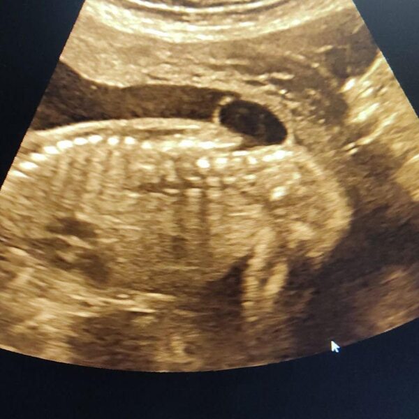 Con éxito, realizan cuarta cirugía fetal para cierre de espina bífida en FCM-UNA - Unicanal