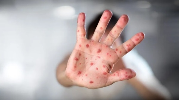 Salud alerta sobre los síntomas de la viruela del mono y reporta dos casos sospechosos