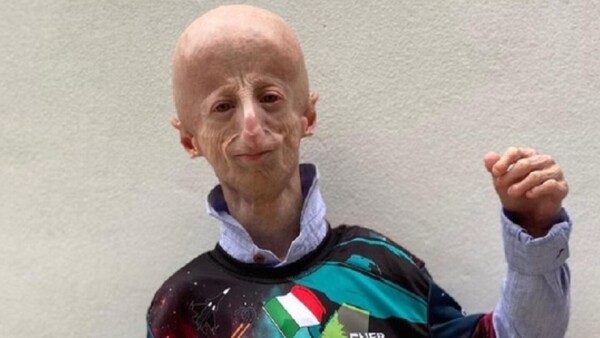 Muere con 28 años el italiano que visibilizó el síndrome que le envejecía prematuramente
