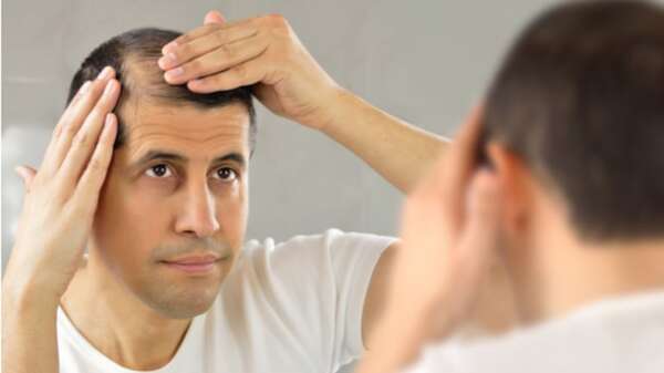 Día de la Calvicie: ¿cómo la pérdida de pelo impacta en la salud mental? - Estilo de vida - ABC Color