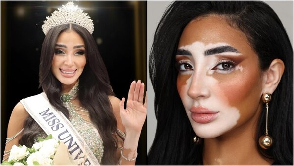 ¡Miss Egipto, es la primera mujer con vitíligo que concursará en Miss Universo!