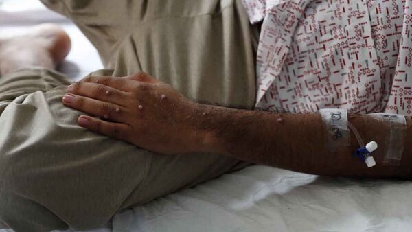 Paraguay se mantiene sin casos de viruela del mono, según Salud