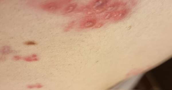 Diario HOY | “Fuego de San Antonio”: la verdad detrás del mito de la ‘línea media del abdomen’