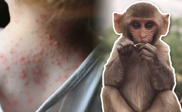 Posible caso de viruela del mono detectado en Encarnación - Noticiero Paraguay