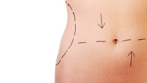 Mitos y verdades sobre la liposucción: ¿es realmente peligrosa?