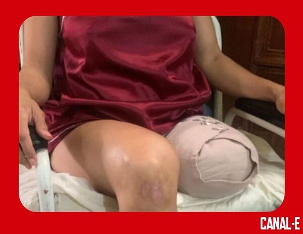 POR CULPA DE CABLES SUELTOS, MUJER PIERDE SU PIERNA Y AHORA EXIGE JUSTICIA