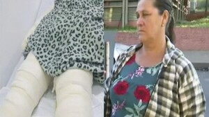 Quemada al desplumar gallinas necesita ayuda