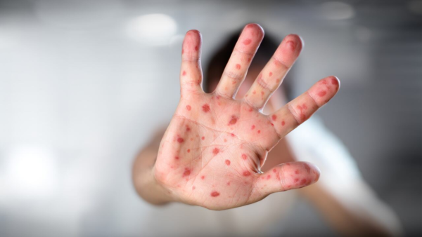 Descartan caso sospechoso de viruela símica en Encarnación
