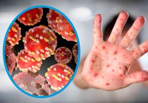 Descartan casos sospechosos de viruela del mono en Itapúa - El Trueno