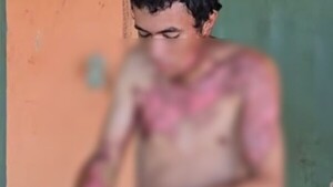Pidió que le inviten gaseosa, pero le quemaron con agua caliente