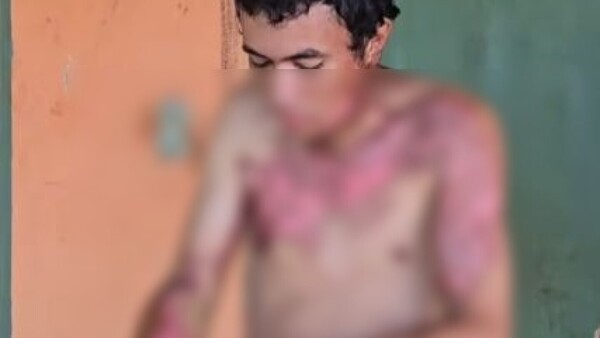 Pidió que le inviten gaseosa, pero le quemaron con agua caliente