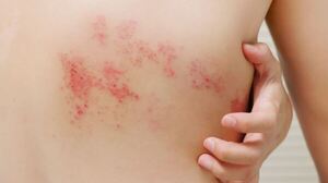 Epidermólisis bullosa: buscan sensibilizar sobre “la piel de mariposa”