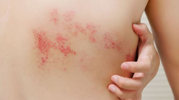 Epidermólisis bullosa: buscan sensibilizar sobre “la piel de mariposa”