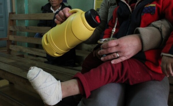 Alarmante número de quemaduras infantiles por accidentes en el hogar