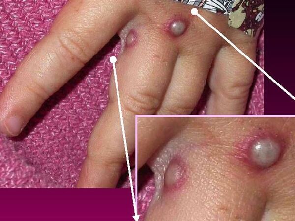 La viruela del mono tiene nuevo nombre: la OMS la denominó “mpox”