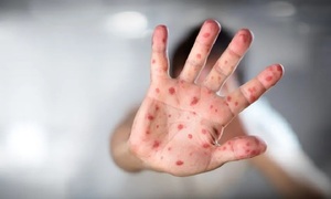 Detectan caso sospechoso de Mpox en una escuela de Luque y el MEC emite recomendaciones de seguridad - OviedoPress