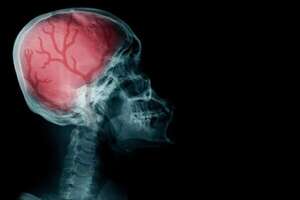 Reconociendo los síntomas de un ACV: un llamado a la acción en el Día Mundial del Accidente Cerebrovascular - Estilo de vida - ABC Color