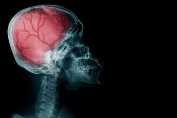 Reconociendo los síntomas de un ACV: un llamado a la acción en el Día Mundial del Accidente Cerebrovascular - Estilo de vida - ABC Color