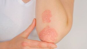 Día Mundial de la Psoriasis: un nuevo paradigma en el tratamiento y la esperanza para los pacientes - El Independiente