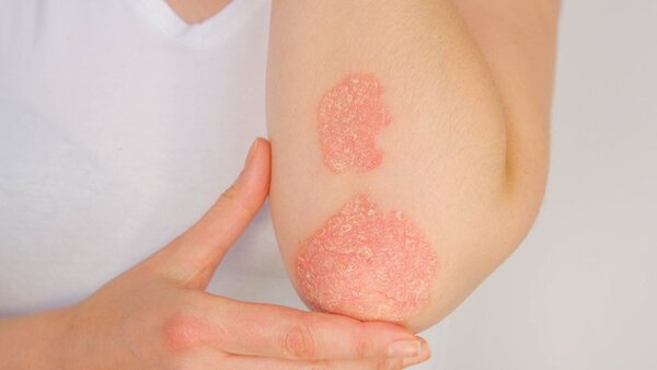 Día Mundial de la Psoriasis: un nuevo paradigma en el tratamiento y la esperanza para los pacientes - El Independiente