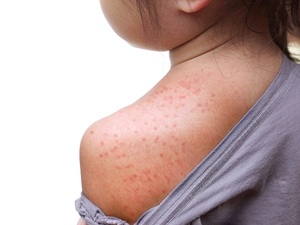Descartan supuesto caso de viruela símica en Luque - 1000 Noticias