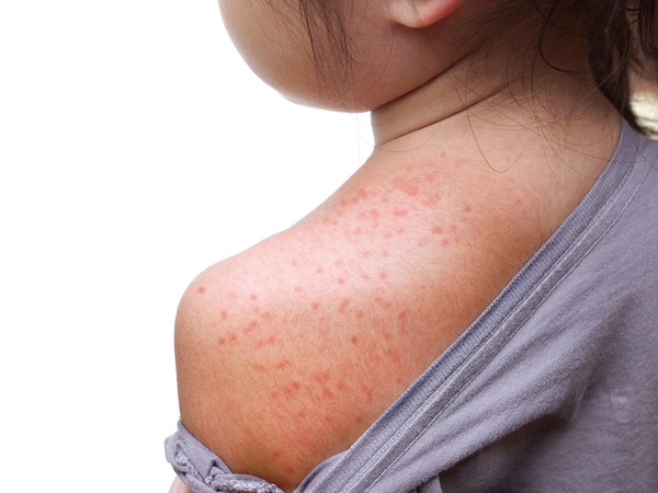 Descartan supuesto caso de viruela símica en Luque - 1000 Noticias