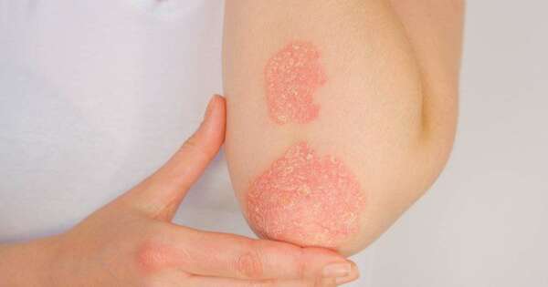 Diario HOY | Día Mundial de la Psoriasis: avances que transforman vidas y rompen estigmas