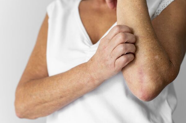 Día Mundial de la Psoriasis: Nuevo paradigma y apoyo en Paraguay - ADN Digital