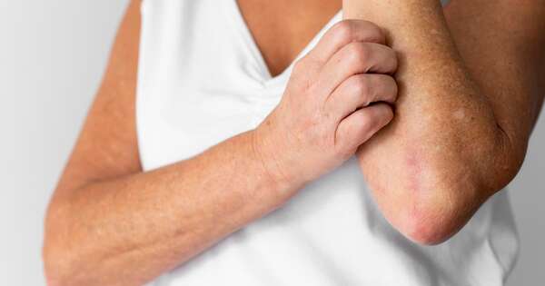 La Nación / La psoriasis no tiene cura, pero hay tratamientos que reducen al mínimo los síntomas, afirman