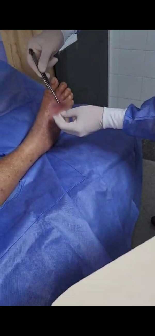 Tratamiento con larvas de mosca evita amputación de pie diabético en Clínicas - Unicanal