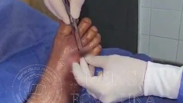 Inédito: usan larvas de mberú hovy para evitar amputación de pie diabético