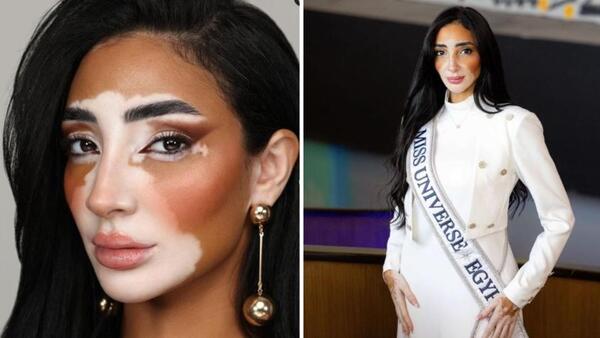 Logina Salah, la primera candidata con vitiligo en Miss Universo