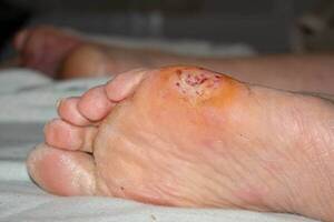 ¡Increíble! Con larvas de moscas le salvaron un pie que ya los médicos iban a amputar