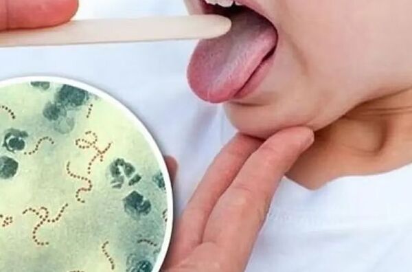 Ciudad del Este: Suspenden clases tras confirmarse caso de Streptococcus - trece