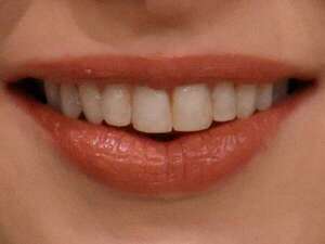 Carillas dentales para sonrisas sorprendentes  - Estilo de vida - ABC Color