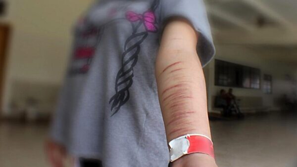 Alarmantes casos de autolesiones con objetos cortantes en escuelas